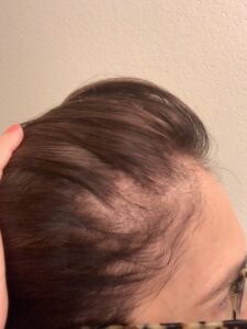 Hair Loss Journey Before