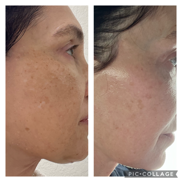 5 Month Comparison Agency Skincare Review 600x600 